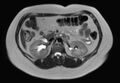 Normal liver MRI with Gadolinium (Radiopaedia 58913-66163 Axial T2 13).jpg