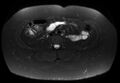 Normal liver MRI with Gadolinium (Radiopaedia 58913-66163 Axial T2 fat sat 7).jpg