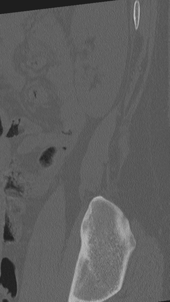 File:Normal lumbar spine CT (Radiopaedia 46533-50986 Sagittal bone window 5).png