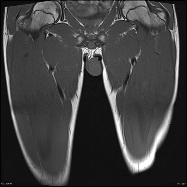 File:Normal muscles (Radiopaedia 24221-24491 Coronal T1 3).jpg