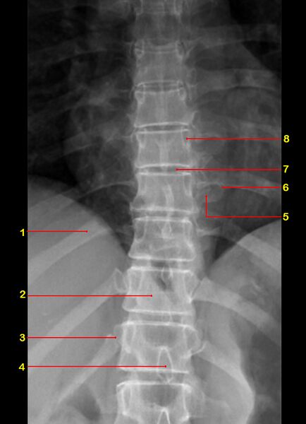 File:Normal radiographic anatomy of the thoracic spine (Radiopaedia 43007-46261 AP 1).jpg