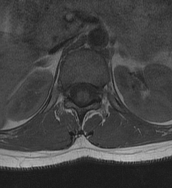 File:Normal thoracic spine MRI (Radiopaedia 41033-43781 Axial T1 30).jpg