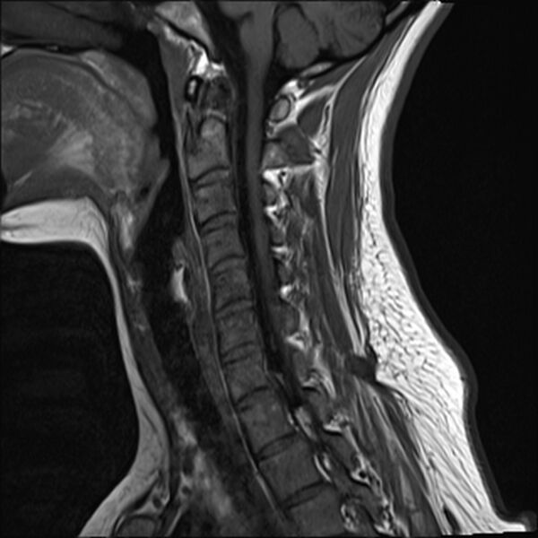 File:Normal trauma cervical spine MRI (Radiopaedia 32130-33071 Sagittal T1 6).jpg
