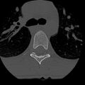Normal trauma spine imaging (age 16) (Radiopaedia 45335-49358 Axial bone window 113).jpg