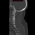 Occipital condyle fracture (Radiopaedia 18366-18208 Sagittal bone window 29).jpg