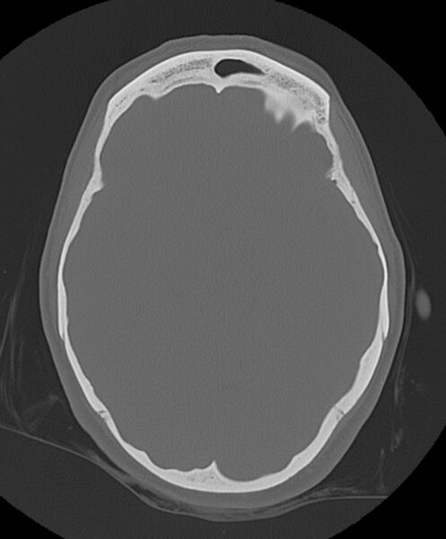 File:Occipital condyle fracture (Radiopaedia 61165-69056 Axial bone window 13).jpg