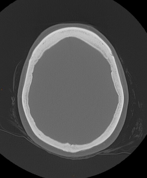 File:Occipital condyle fracture (Radiopaedia 61165-69056 Axial bone window 7).jpg