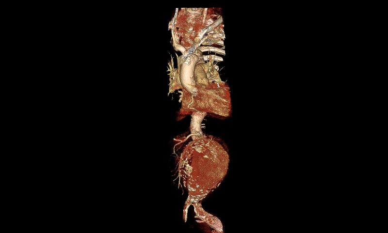 File:Abdominal aortic aneurysm- extremely large, ruptured (Radiopaedia 19882-19921 3D 2).jpg