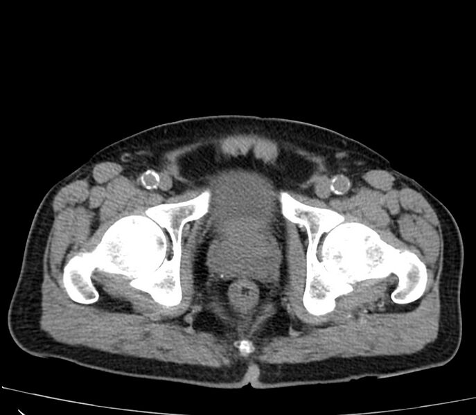 File:Abdominal aortic aneurysm (Radiopaedia 22421-22458 non-contrast 55).jpg