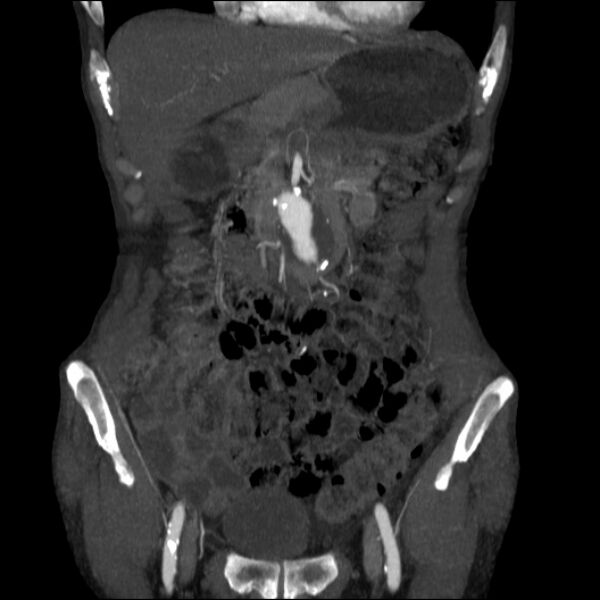 File:Abdominal aortic aneurysm (Radiopaedia 23703-23856 Coronal C+ arterial phase 4).jpg