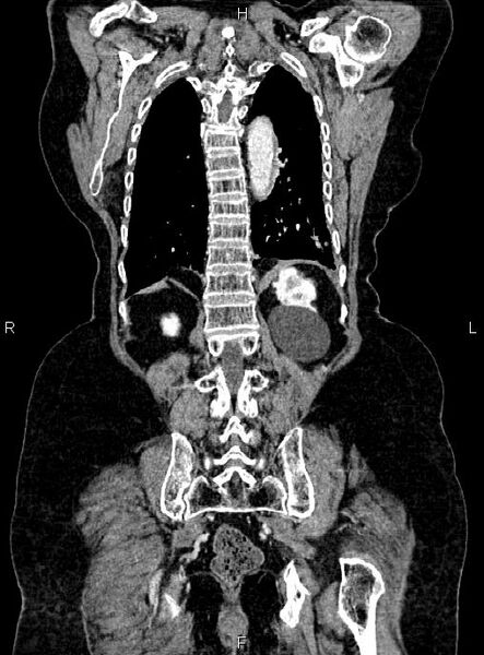File:Abdominal aortic aneurysm (Radiopaedia 85063-100606 Coronal C+ arterial phase 47).jpg