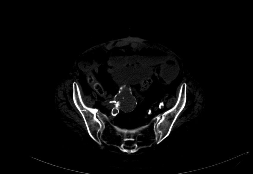 Abdominal aortic aneurysm - impending rupture (Radiopaedia 19233-19246 B 48).jpg