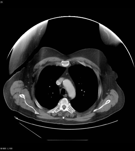 File:Abdominal aortic aneurysm with intramural hematoma then rupture (Radiopaedia 50278-55631 Axial C+ arterial phase 14).jpg