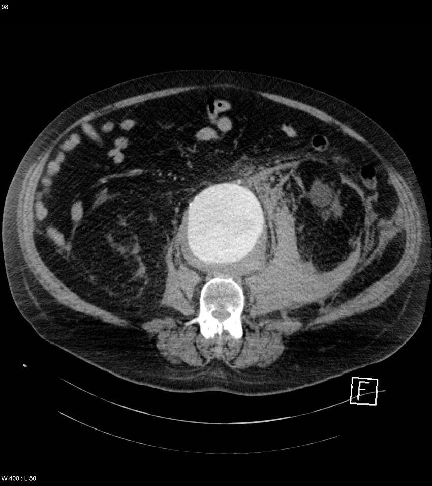 Abdominal aortic aneurysm with intramural hematoma then rupture (Radiopaedia 50278-55632 Axial C+ arterial phase 97).jpg