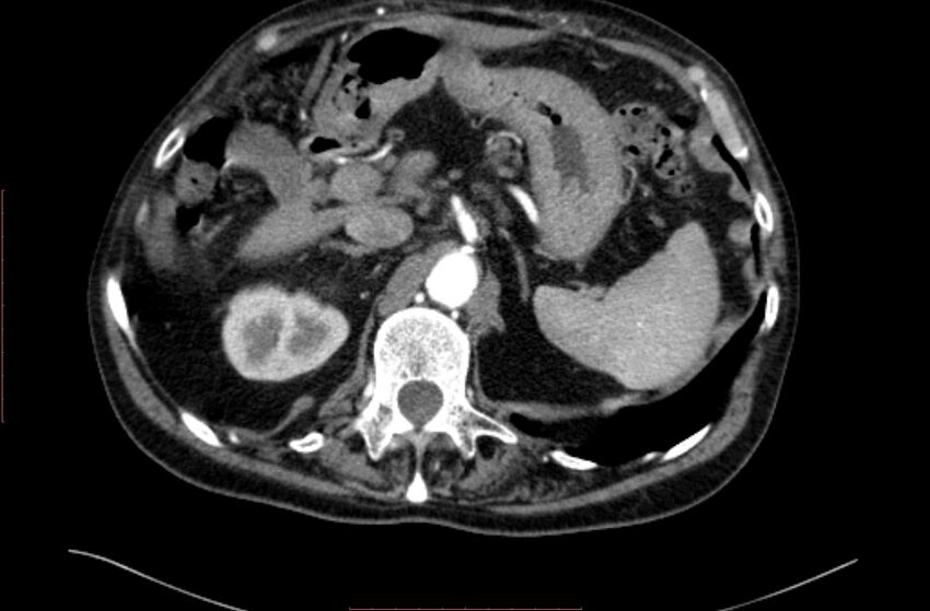 Abdominal aortic interposition tube graft and aneurysm thrombosis (Radiopaedia 71438-81857 Axial C+ arterial phase 16).jpg