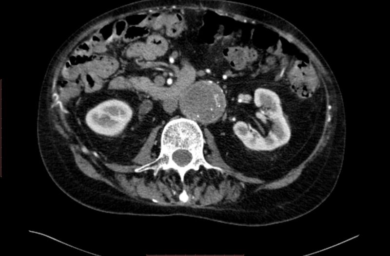 File:Abdominal aortic interposition tube graft and aneurysm thrombosis (Radiopaedia 71438-81857 Axial C+ arterial phase 69).jpg