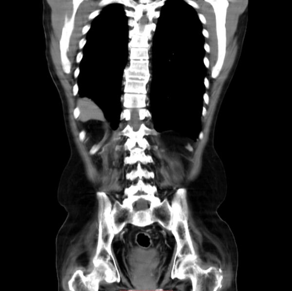 File:Abdominal aortic interposition tube graft and aneurysm thrombosis (Radiopaedia 71438-81857 Coronal C+ arterial phase 22).jpg