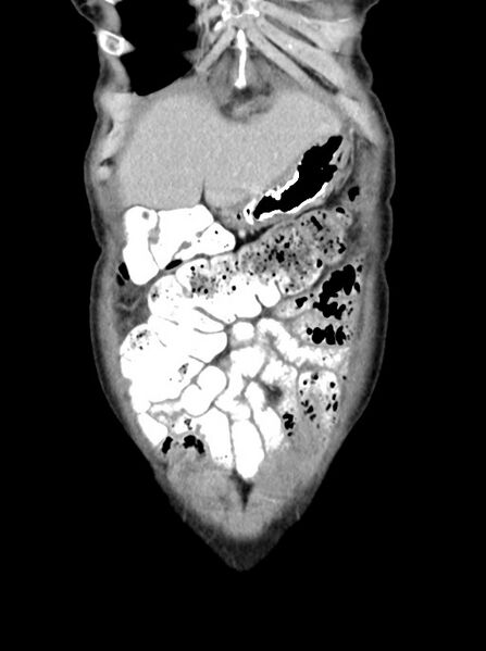 File:Abdominal wall and retroperitoneal tuberculosis (Radiopaedia 88137-104729 Coronal C+ portal venous phase 18).jpg