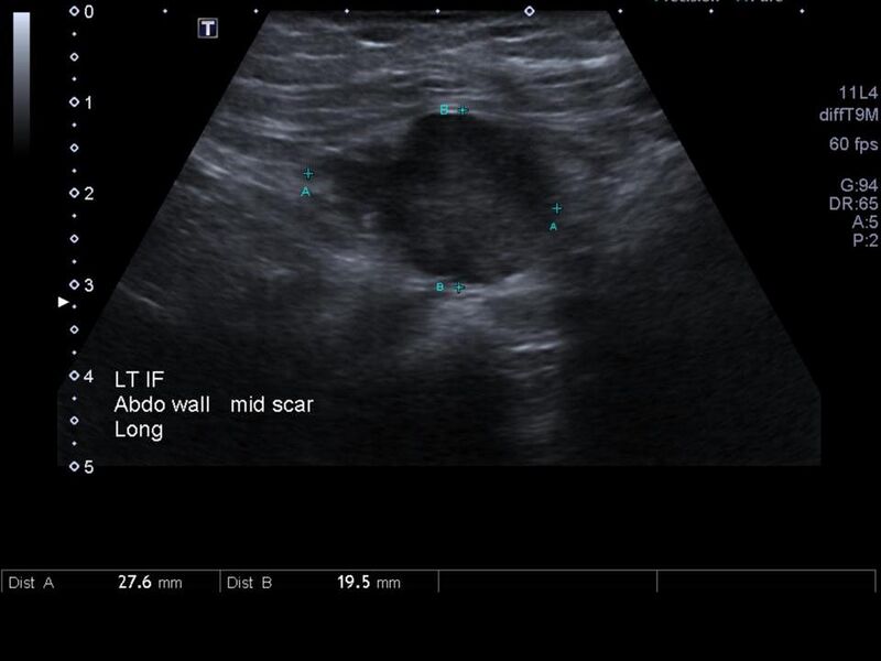 File:Abdominal wall metastasis from colorectal carcinoma (Radiopaedia 31016-31718 Transverse 4).jpg