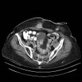 Abdominal wall recurrence after colorectal resection for cancer (Radiopaedia 23444-23523 Axial C+ portal venous phase 30).jpg