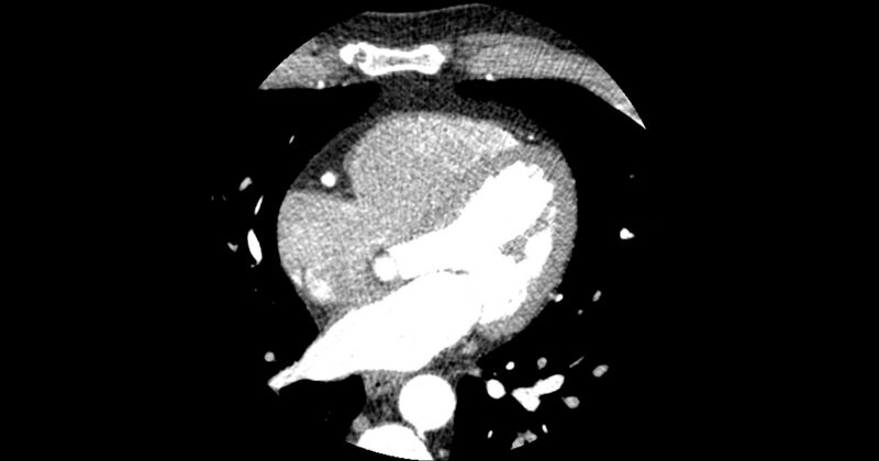 File:Aberrant left main coronary artery (ALMCA) arising from the right sinus with interarterial course (Radiopaedia 63251-71814 Axial C+ arterial phase 101).JPG