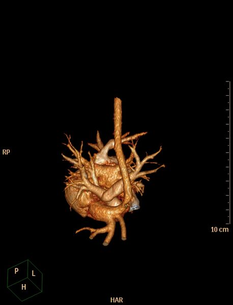 File:Aberrant left pulmonary artery (pulmonary sling) (Radiopaedia 42323-45435 3D reconstruction C+ CTPA 23).jpg