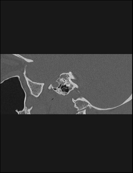 File:Aberrant right internal carotid artery (Radiopaedia 65191-74198 Sagittal non-contrast 71).jpg
