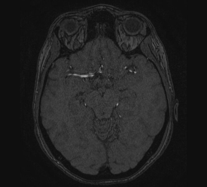 File:Accessory middle cerebral artery and ICA aneurysm (Radiopaedia 22656-22674 MRA 53).jpg