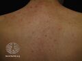 Acne affecting the back images (DermNet NZ acne-acne-back-142).jpg