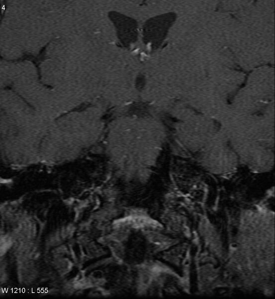 File:Acoustic schwannoma (large with cystic change) (Radiopaedia 5369-7130 Coronal T1 C+ fat sat 1).jpg