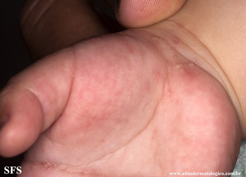 Acropustulosis Infantile (Dermatology Atlas 13).jpg