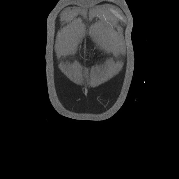 File:Active colonic bleed on CT (Radiopaedia 49765-55025 Coronal art MIP 9).jpg