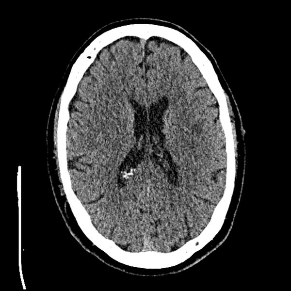 File:Acute A3 occlusion with ACA ischemic penumbra (CT perfusion) (Radiopaedia 72036-82525 Axial non-contrast thins 56).jpg