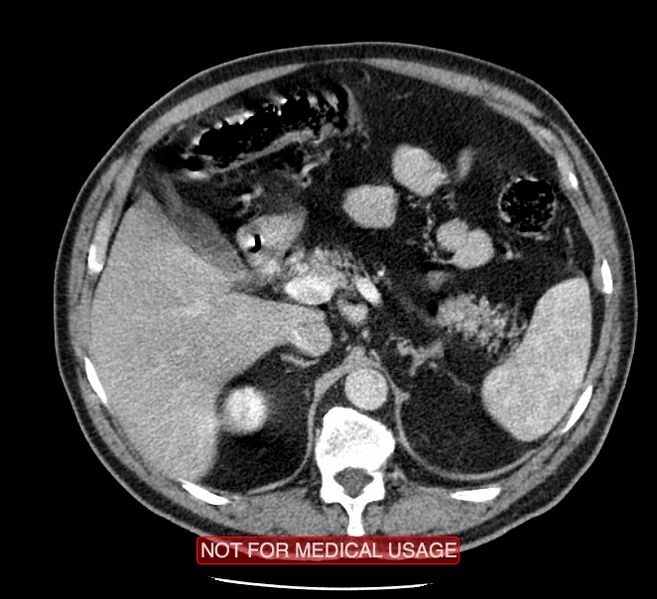 File:Acute aortic dissection - Stanford type A (Radiopaedia 40661-43285 Axial C+ portal venous phase 82).jpg