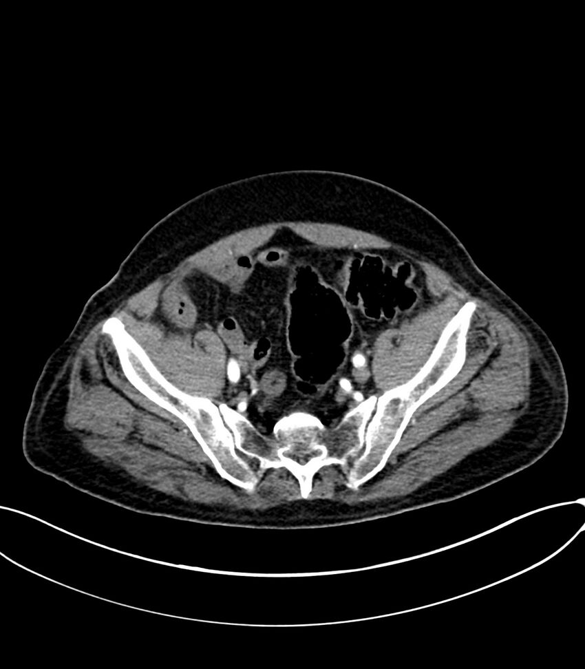 Acute arterial mesenteric ischemia (Radiopaedia 78238-90828 Axial C+ arterial phase 114).jpg