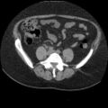Acute cholecystitis and ureteric colic (Radiopaedia 42330-45444 Axial prone 67).jpg