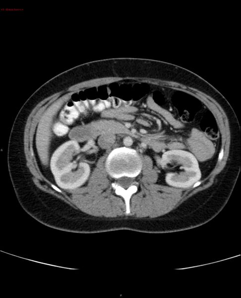 File:Acute gastritis (Radiopaedia 21043-20975 Axial C+ portal venous phase 24).jpg