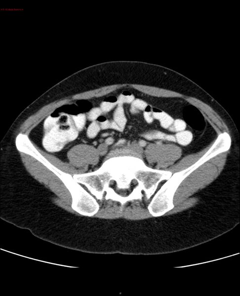 File:Acute gastritis (Radiopaedia 21043-20975 Axial C+ portal venous phase 47).jpg