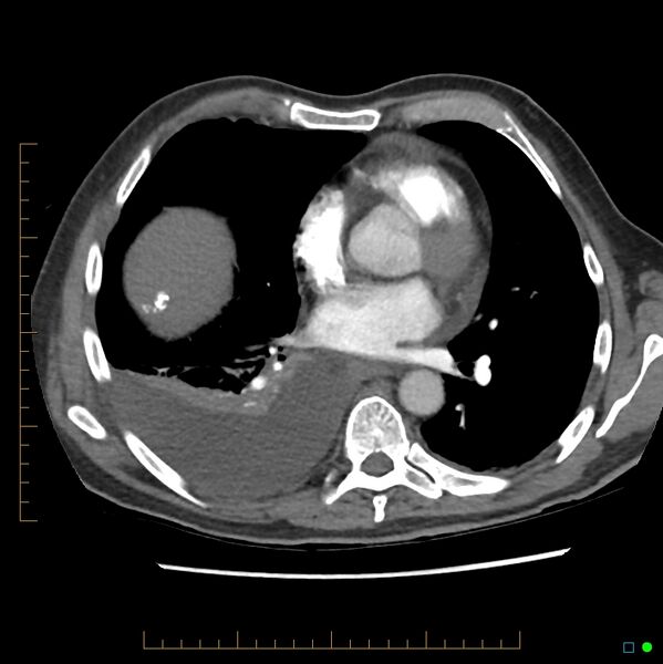 File:Acute hemorrhage into adrenal metastasis from NSCLC (Radiopaedia 43135-46429 Axial C+ CTPA 1).jpg