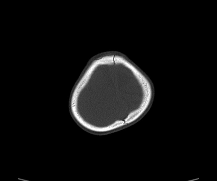 Acute hemorrhagic contusion (Radiopaedia 63660-72336 Axial bone window 61).jpg
