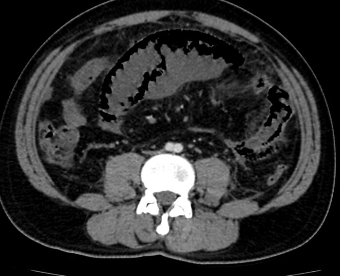 Acute mesenteric ischemia - superior mesenteric artery thrombosis (Radiopaedia 73947-84776 Axial C+ arterial phase 85).jpg