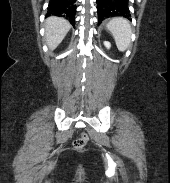File:Acute pancreatitis - Balthazar E (Radiopaedia 29016-29377 Coronal C+ portal venous phase 74).png