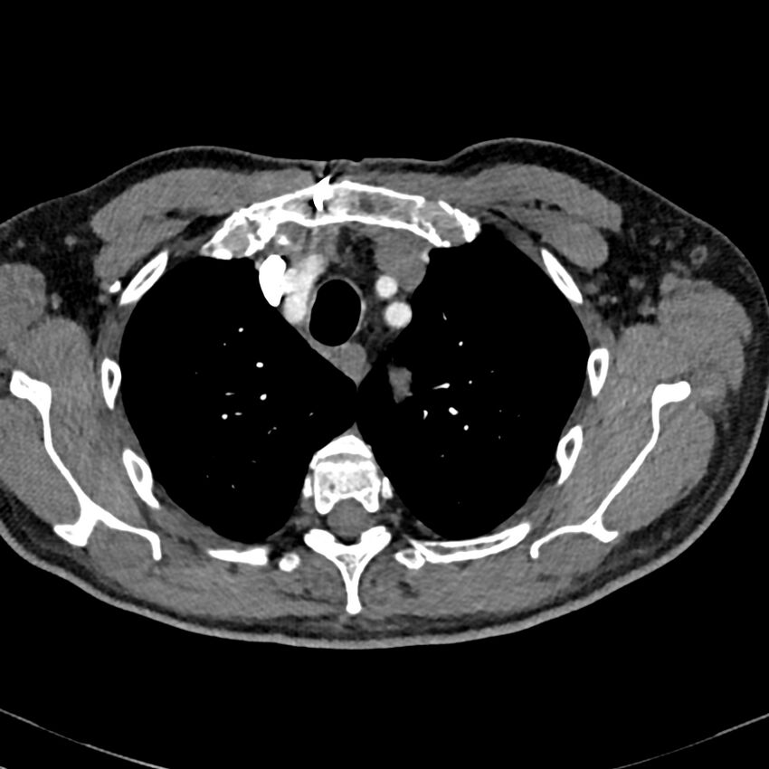 Acute pulmonary embolism (Radiopaedia 81677-95570 Axial C+ CTPA 2).jpg