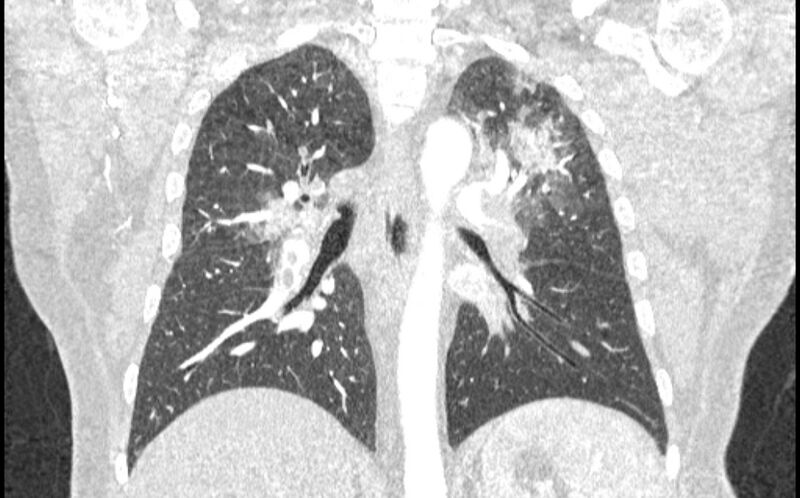 File:Acute pulmonary embolism with pulmonary infarcts (Radiopaedia 77688-89908 Coronal lung window 60).jpg
