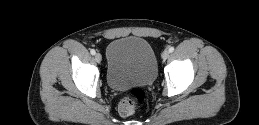 Acute sigmoid colon diverticulitis (Radiopaedia 55507-61976 Axial C+ portal venous phase 109).jpg