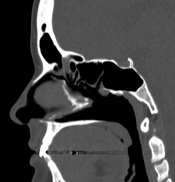 File:Acute sinusitis (Radiopaedia 22419-22455 Sagittal non-contrast 14).jpg
