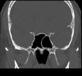 Acute sinusitis (Radiopaedia 23161-23215 Coronal bone window 48).jpg