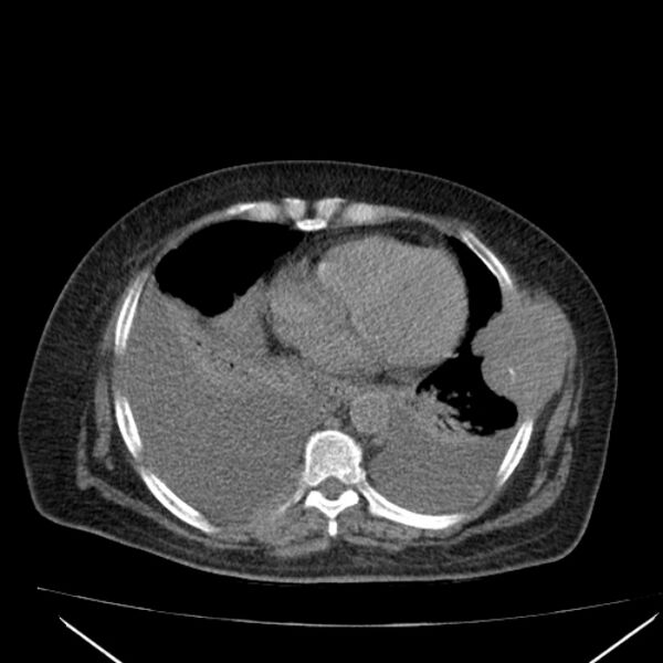 File:Acute tubular necrosis (Radiopaedia 28077-28334 Axial non-contrast 5).jpg