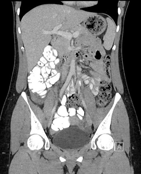 File:Acute uncomplicated appendicitis (Radiopaedia 61374-69304 Coronal C+ portal venous phase 45).jpg