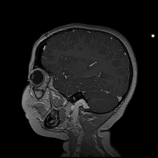 File:Adamantinomatous craniopharyngioma (Radiopaedia 77407-89529 H 36).jpg